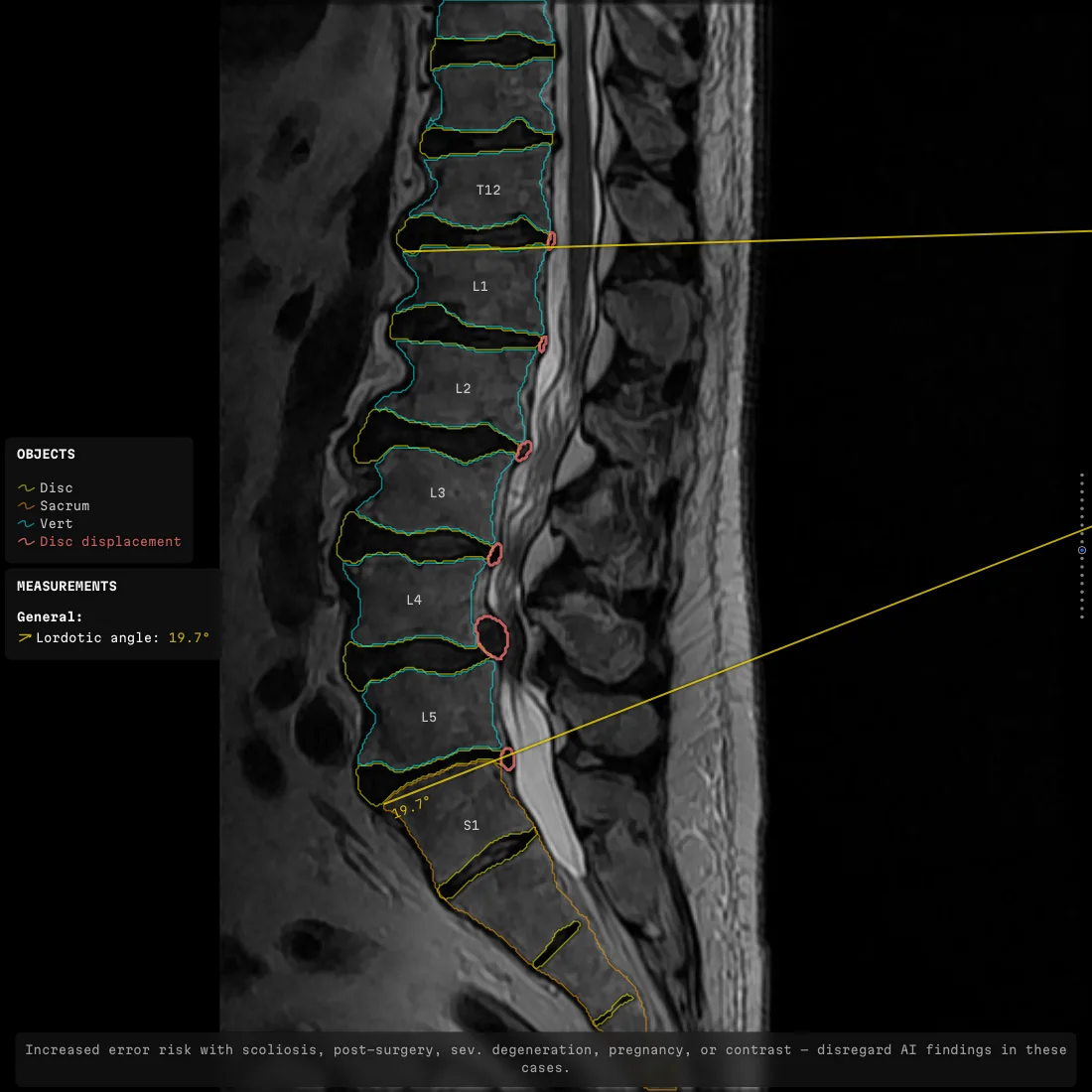 a sagittal lumbar slice with the lordotic angle drawn along two vertebral endplates and its value printed at the vertex