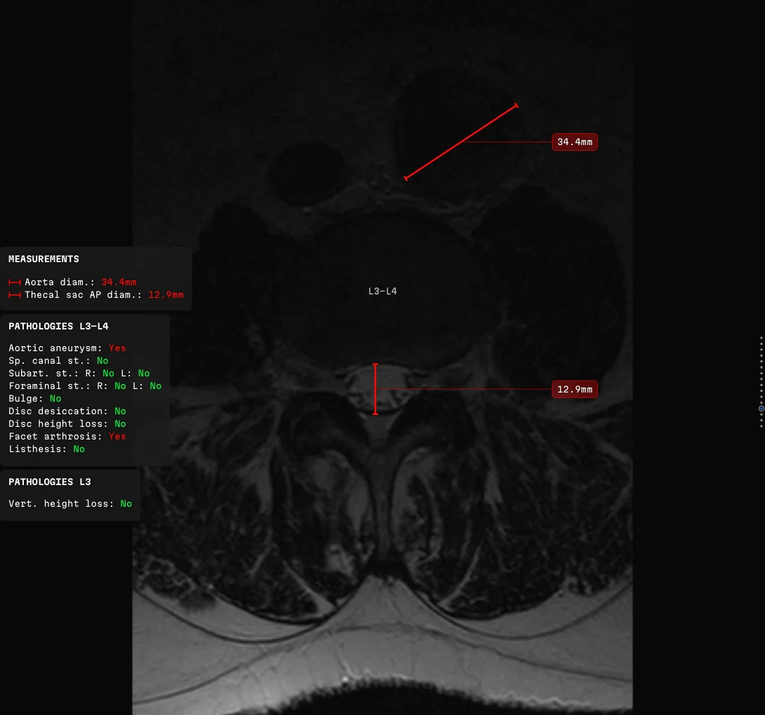 An axial slice at a lumbar disc: the abdominal aorta measured at 34.4 mm in red, and a panel beside it naming aortic aneurysm as present
