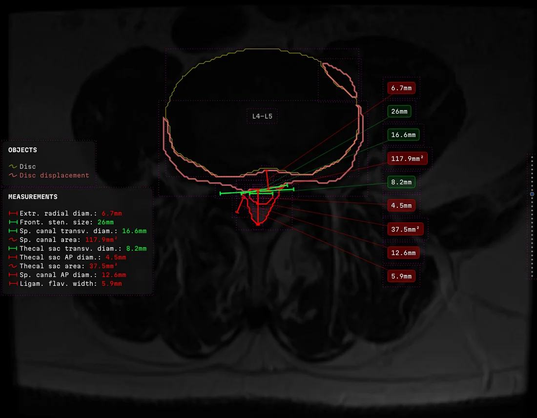 An axial lumbar slice with the disc and the canal outlined, nine measurements led out to one column of labels on the right, and a dashed rectangle drawn round every object on the frame