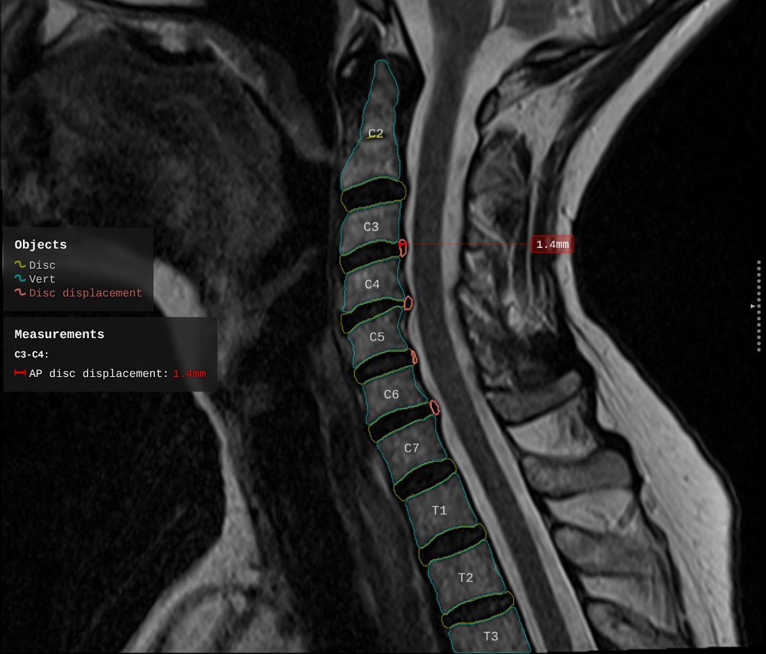 A sagittal cervical series with every level outlined and named, a measurement and two panels of text