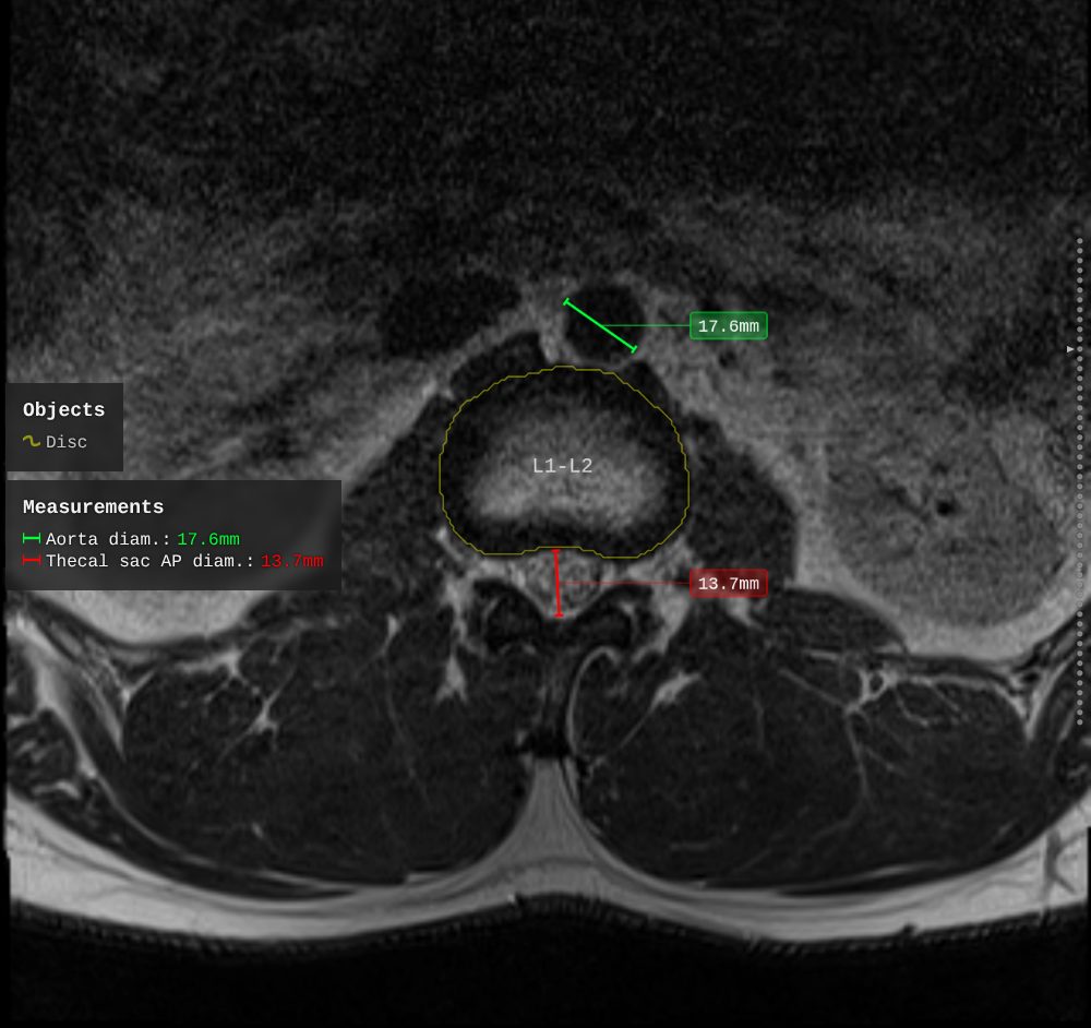 An axial slice with the aorta measured in green and the thecal sac in red, both values repeated in a panel at the left