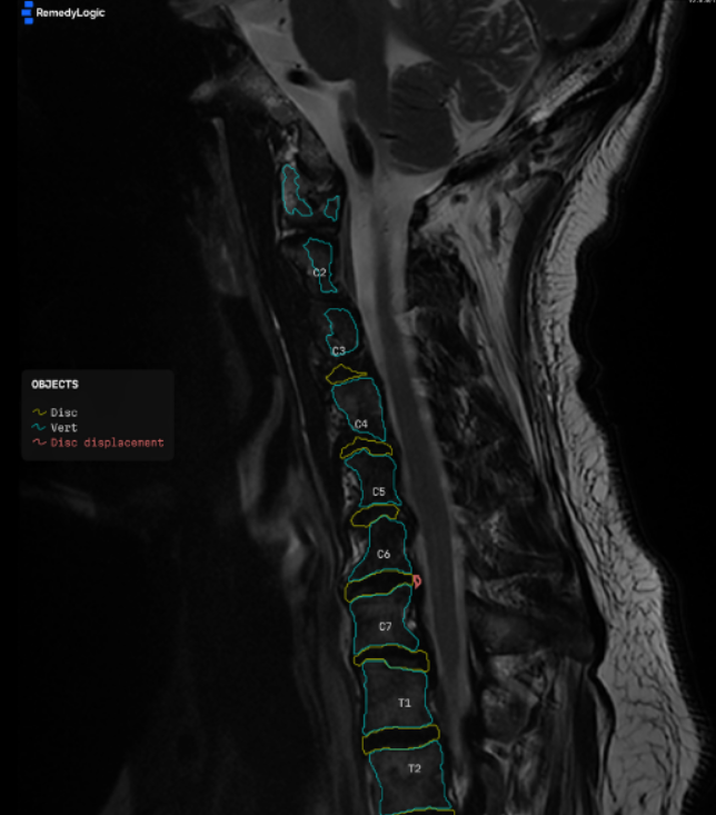 a sagittal cervical series with the analyser's contours drawn on it, the topmost ones sitting off the bone