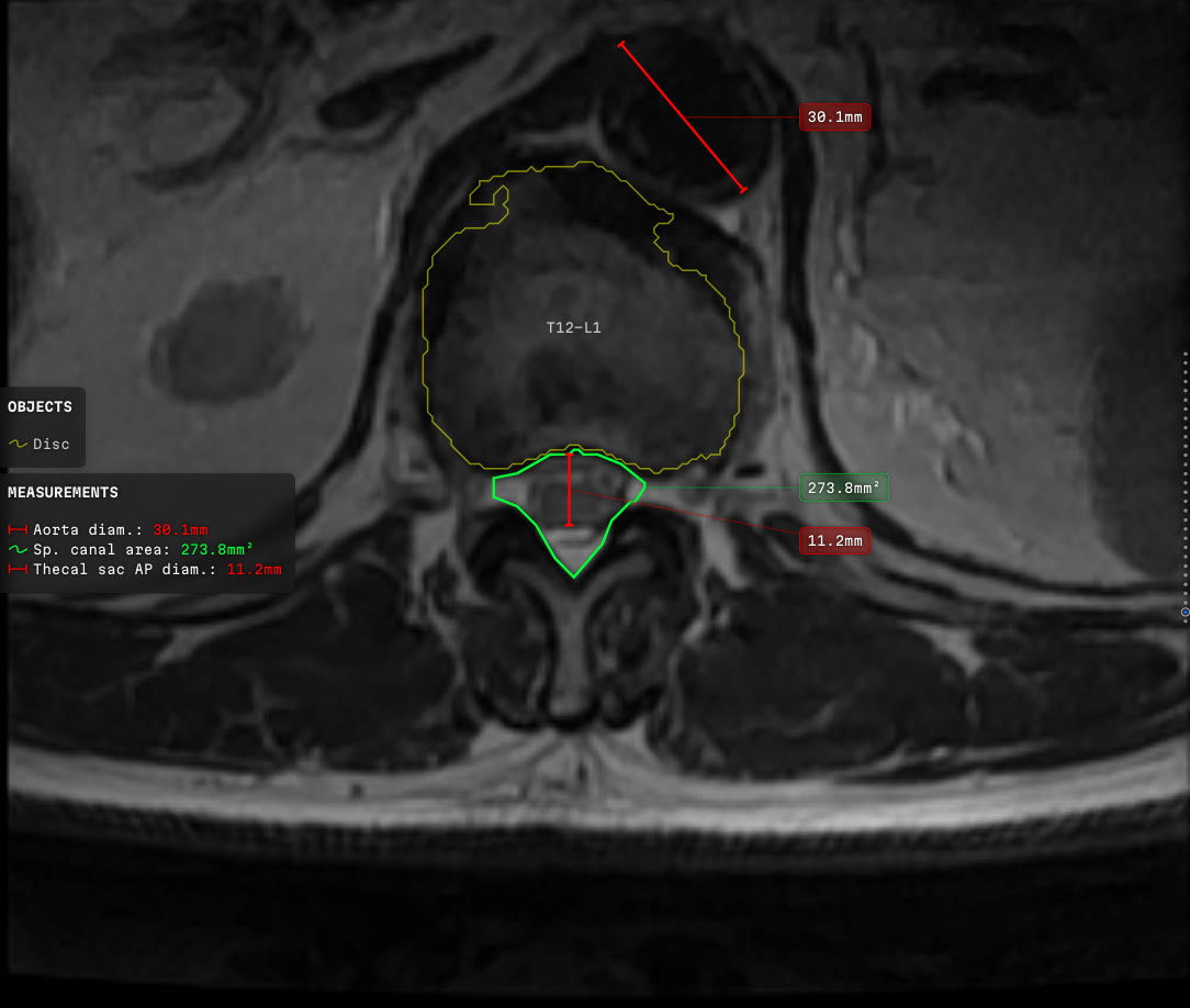 An axial slice at the thoracolumbar junction from the same study. The abdominal aorta is measured across its width and the value is printed in red, meaning the analyser marked it as out of range. The disc is outlined in yellow, the dural sac in green with its area and its front-to-back diameter, and every value stands clear of the anatomy on its own leader.