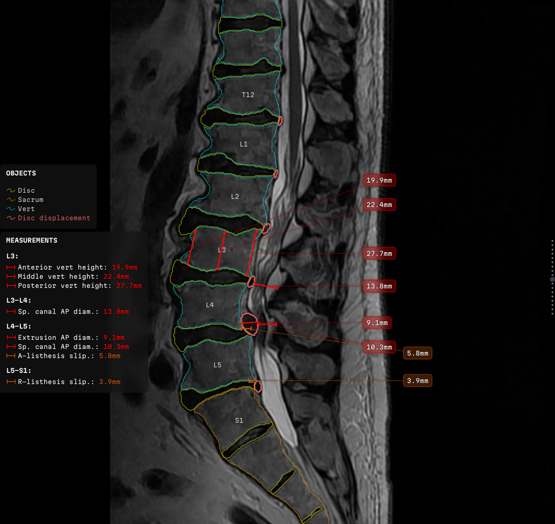 A sagittal slice of the lower spine. Vertebral bodies, discs, the sacrum and a displaced disc are outlined and the levels named, vertebral heights and canal diameters are drawn across the anatomy, and eight millimetre values stand off it in two columns down the right, each on its own leader. A panel at the left lists the measurements grouped by level.