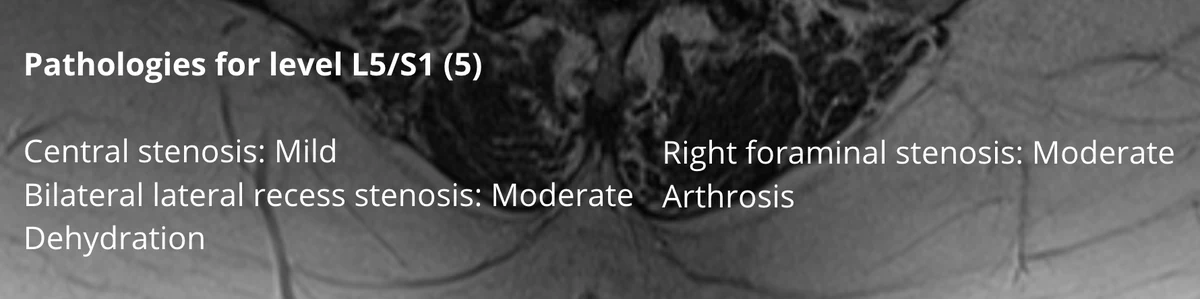 A panel over an axial slice listing five findings for the L5/S1 level, three of them carrying a severity word