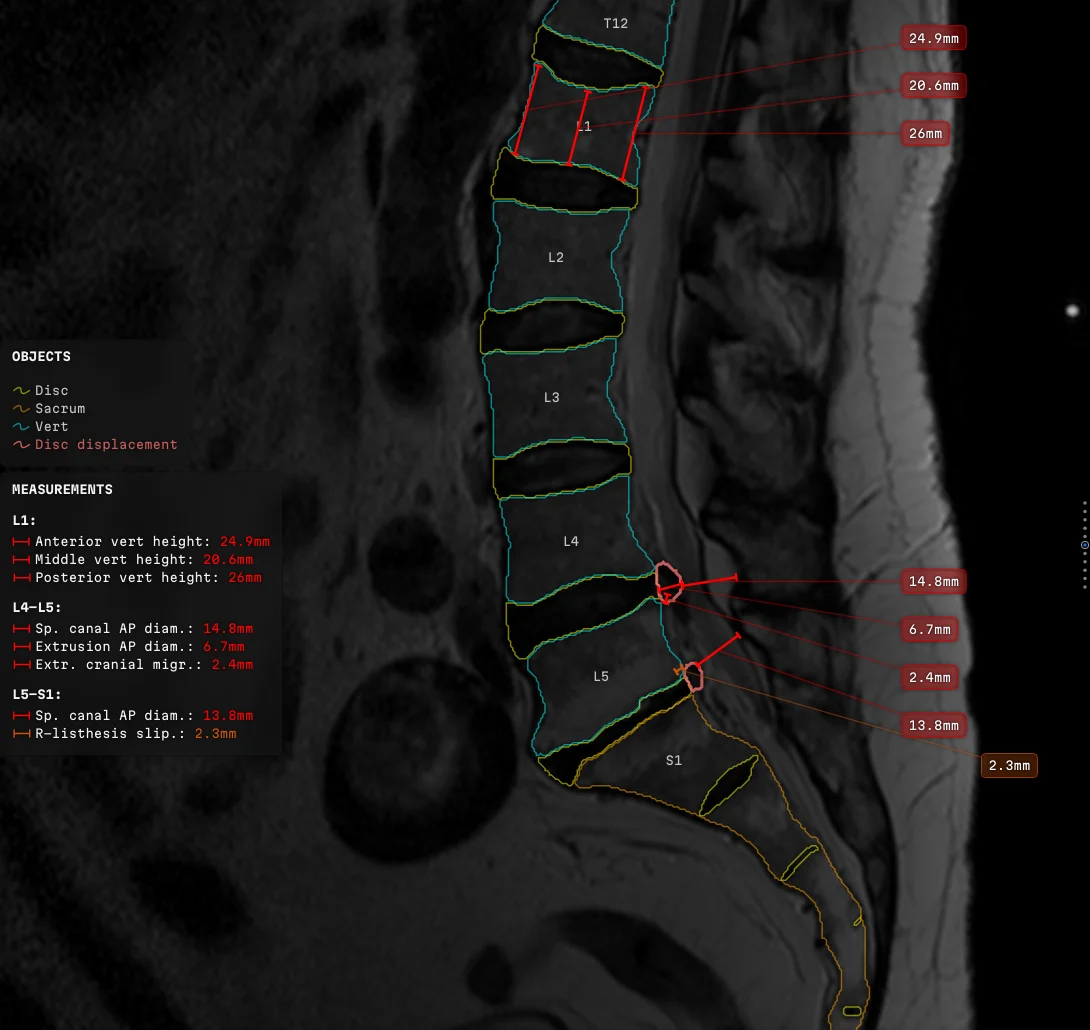 A sagittal lumbar slice with every vertebra, disc and the sacrum outlined and named, eight measurements led out to two columns of labels, and two text panels