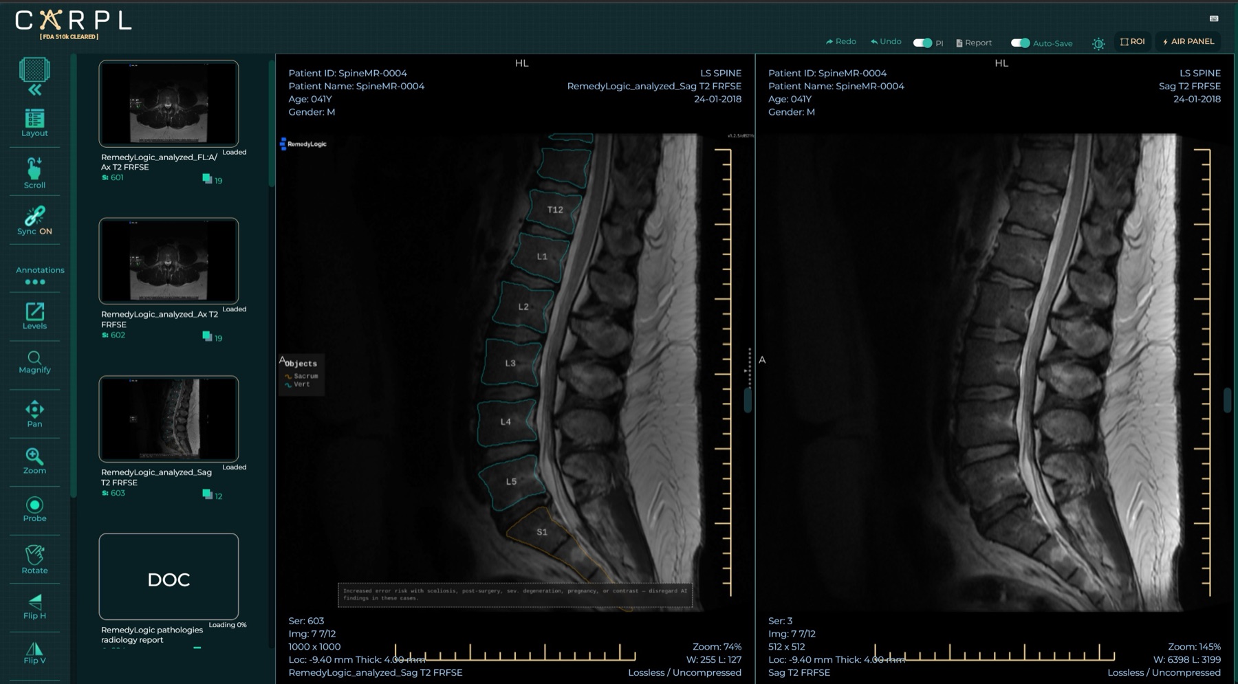 The overlay in the CARPL platform, with the same study shown beside it untouched