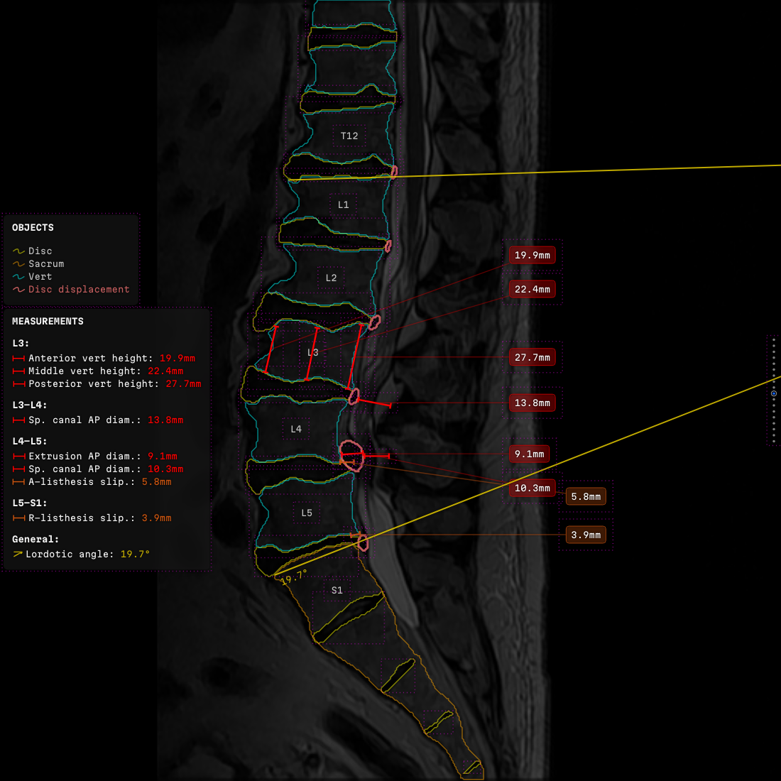A sagittal lumbar frame with the layout guides switched on, a dashed rectangle drawn round every vertebra, disc, level name, label plate and text panel