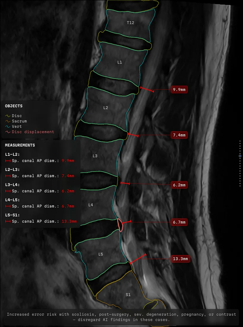 A sagittal lumbar slice with five canal measurements led out to five labels standing in one vertical column