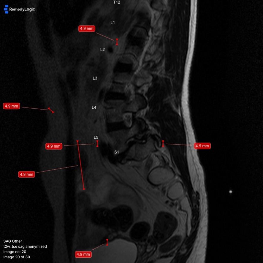 six labels all reading 4.9 mm thrown out from the middle of a sagittal slice in every direction, each on its own leader