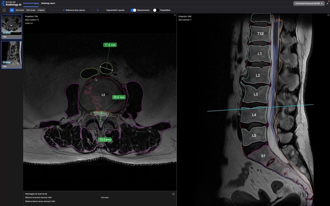 The overlay drawn live in a two-plane viewer: contours over both series, measurements and a findings panel on the axial one