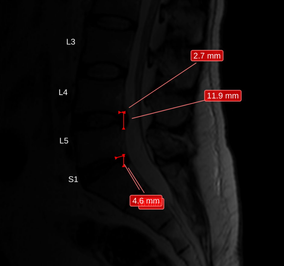 a sagittal lumbar slice with four measurement labels sent outwards at angles, two of them overlapping at the bottom