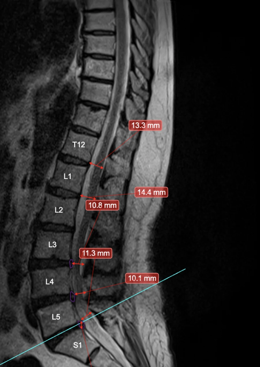 the same slice with the vertebra and disc outlines switched off, the level names and five measurements still drawn