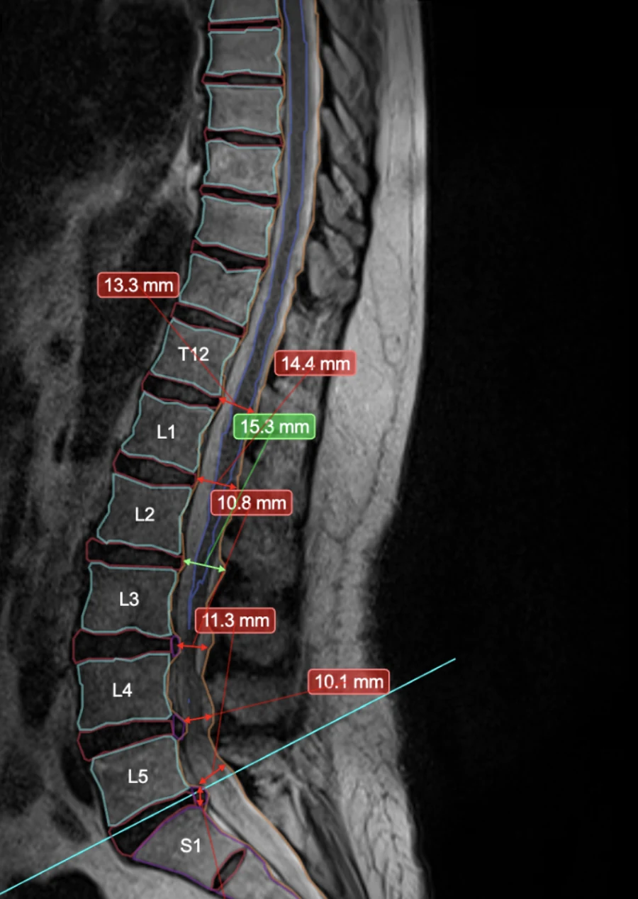 a sagittal lumbar slice with every vertebra and disc outlined, the level names on the bodies and six measurements led out to labels
