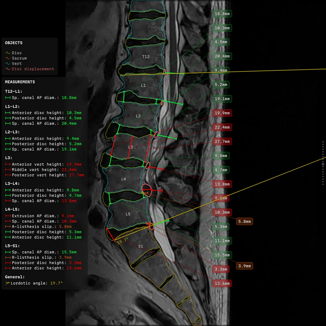 a sagittal lumbar slice at native scale with eighteen measurements led out to one column of labels