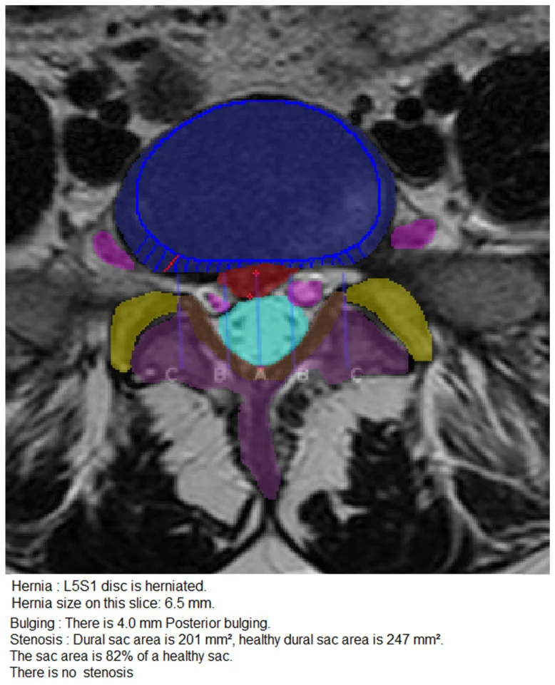 An axial slice with the disc, canal and other structures filled in solid opaque colours, and the hernia size, bulging and dural sac area written as lines of text underneath