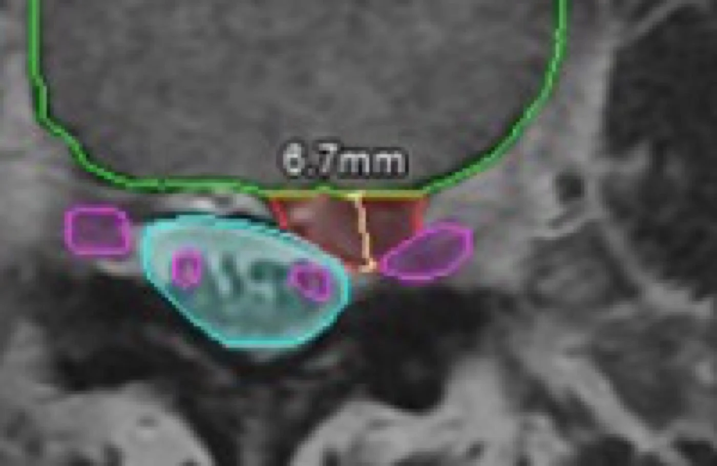 An axial slice with a disc outlined in green, a measurement printed across the outline, and a value inside a cyan region obscured by two magenta contours