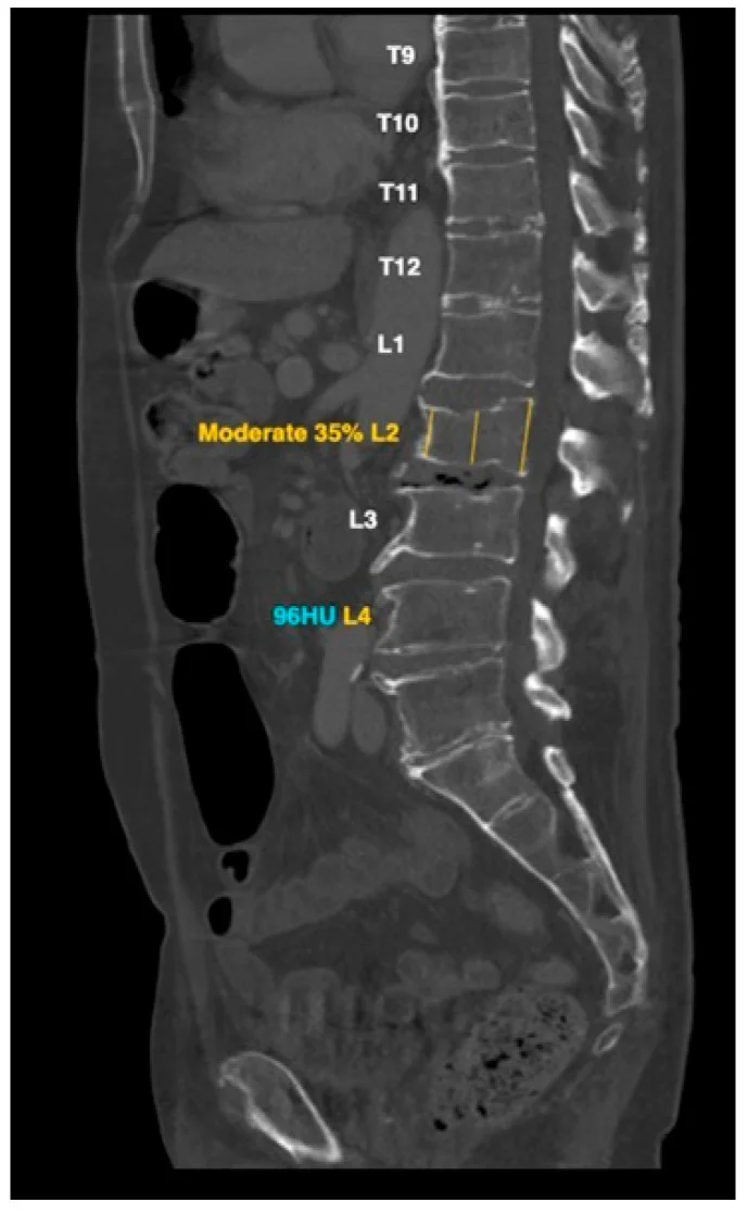 A sagittal CT of the spine with the levels named down the column and two values, a percentage and a density, set in the empty soft tissue to the left of the vertebrae