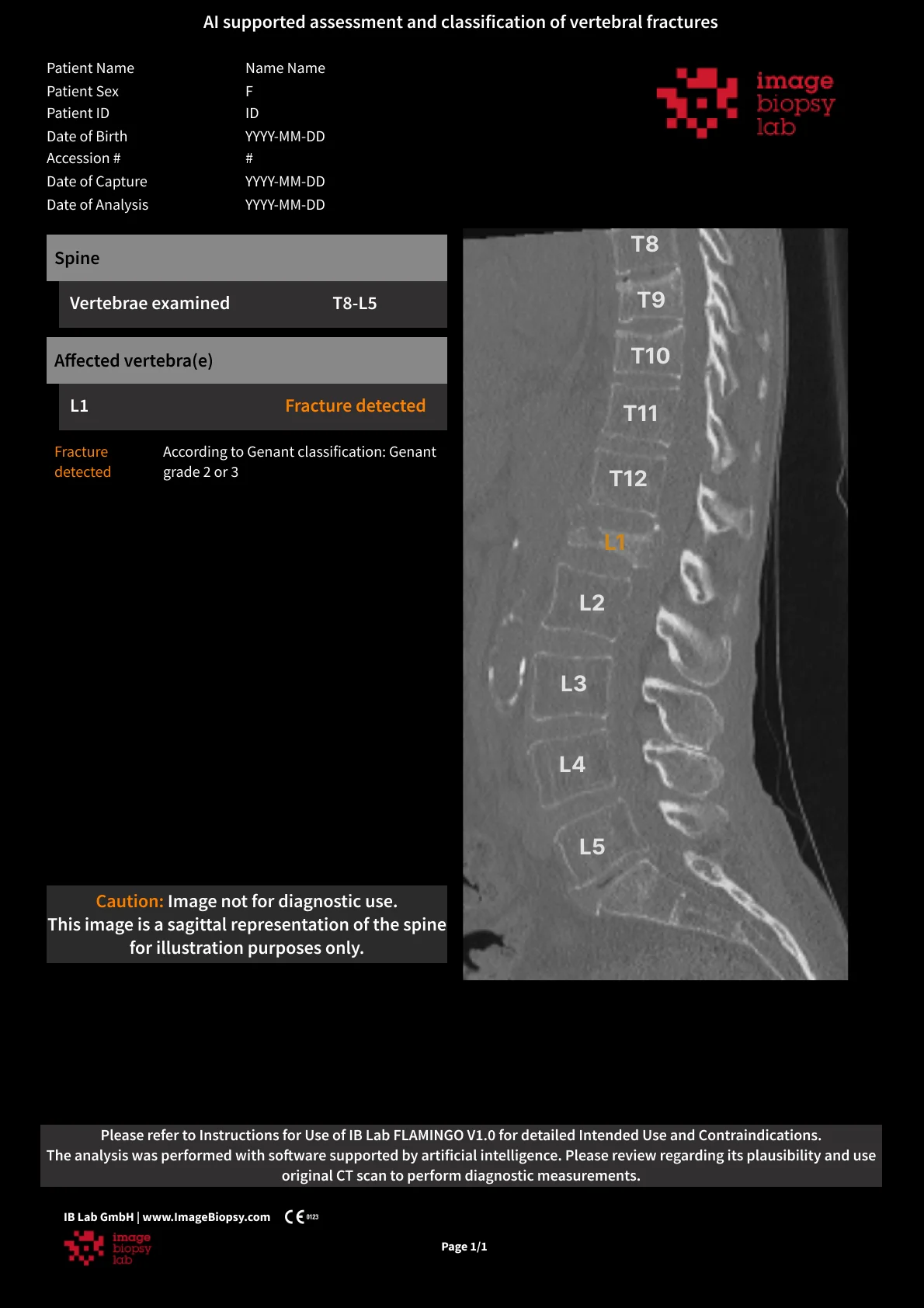 A vertebral fracture report: a sagittal CT carrying only level names, one of them orange, with the fracture and its grade written in a table on the left