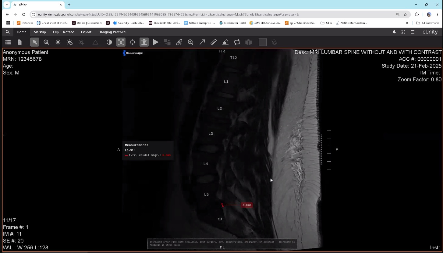 a sagittal lumbar slice in eUnity with a measurement drawn on it in red and a measurements panel beside it