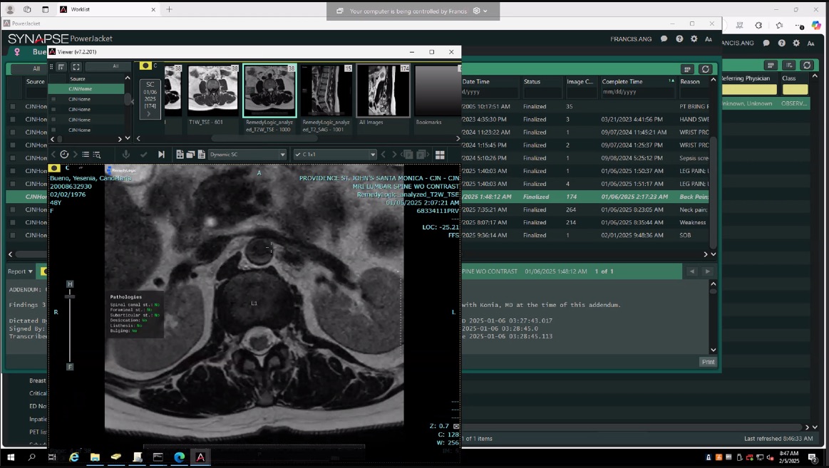 an axial lumbar slice inside Fujifilm Synapse with a panel of findings drawn on the frame